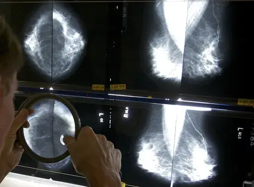 A radiologist uses a magnifying glass to check mammograms for breast cancer in Los Angeles, May 6, 2010. An influential U.S. task force now says women should get screened for breast cancer every other year starting at age 40. The U.S. Preventive Services Task Force announced the updated guidance Tuesday, April 30, 2024. (AP Photo/Damian Dovarganes, File)